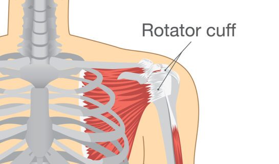 Unfallbedingte Gesundheitsbeschädigung bei Rotatorenmanschettenläsion